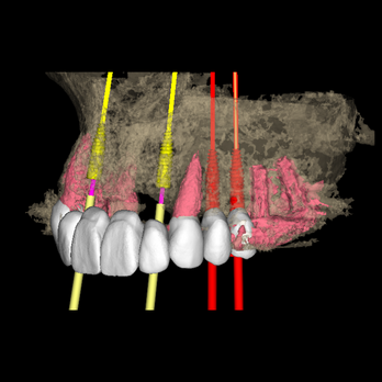 Singlepartial implant planning