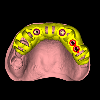 DSD Singlepartial implant planning