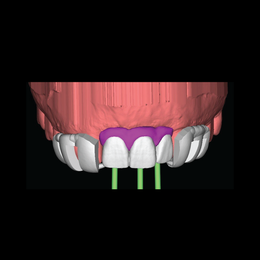 DSD Natural Restorations Temps