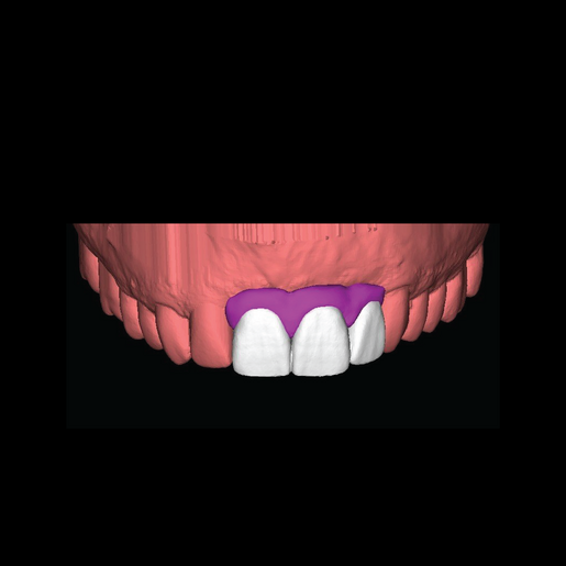 DSD Natural Restorations3 Temps