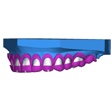 Crown Lengthening 4