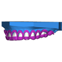 Crown Lengthening 4