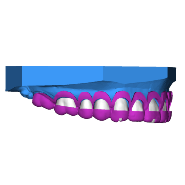 Crown Lengthening 3