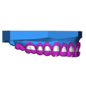 Crown Lengthening 3