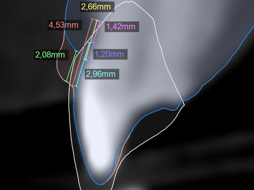 Perio analysis 1
