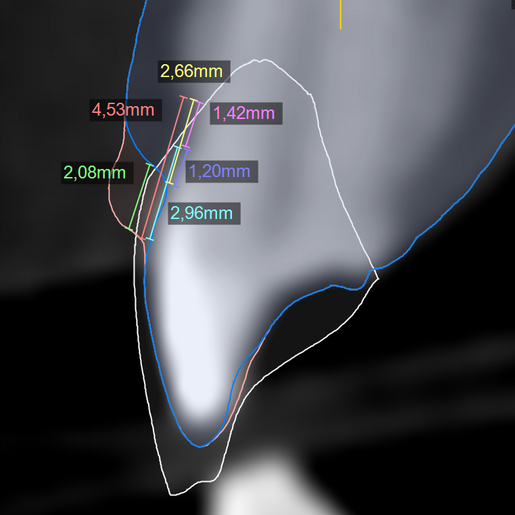 Perio analysis 1