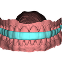 Bite Splint 4