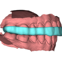 Bite Splint 5