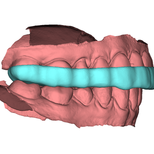 DSD Bite Splint Design
