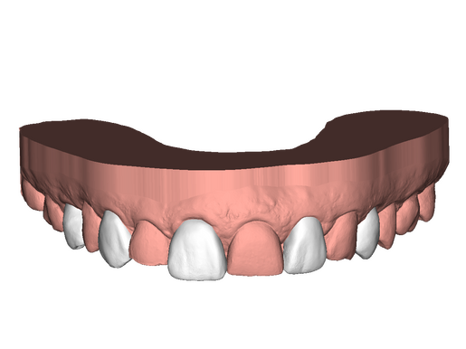 DSD Upper Direct 1